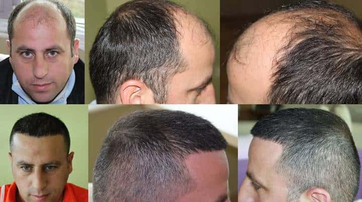 hair transplant in turkey