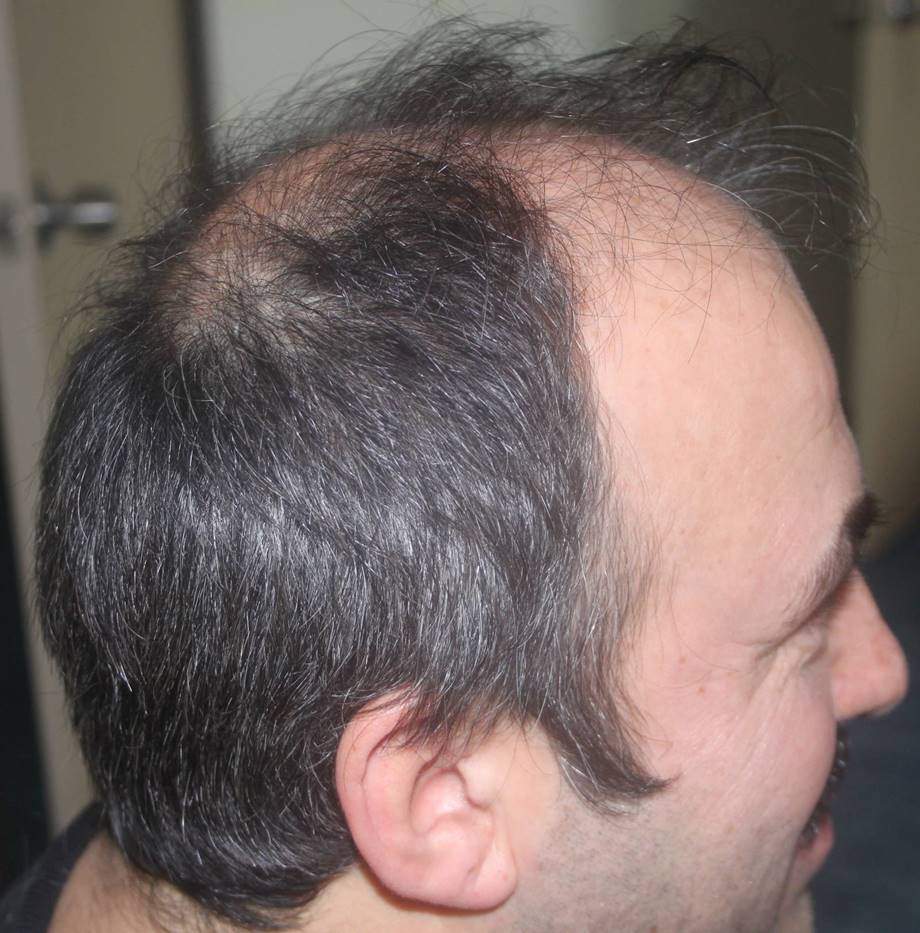 before hair transplant 8000 grafts