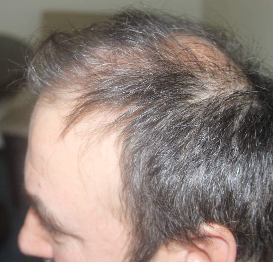 hair implant 8000 grafts