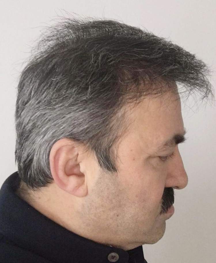 hair restoration 8000 grafts