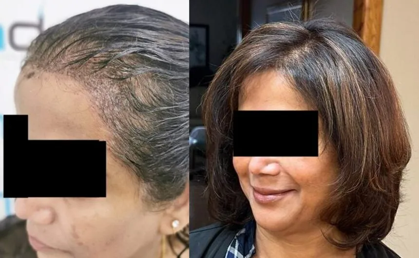 L'aspect naturel chez une femme 10 mois après une greffe de cheveux.